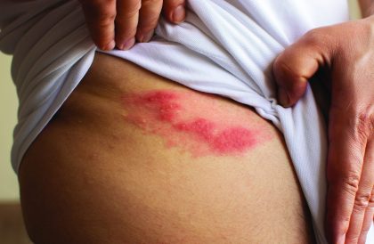 article image - shingles 2
